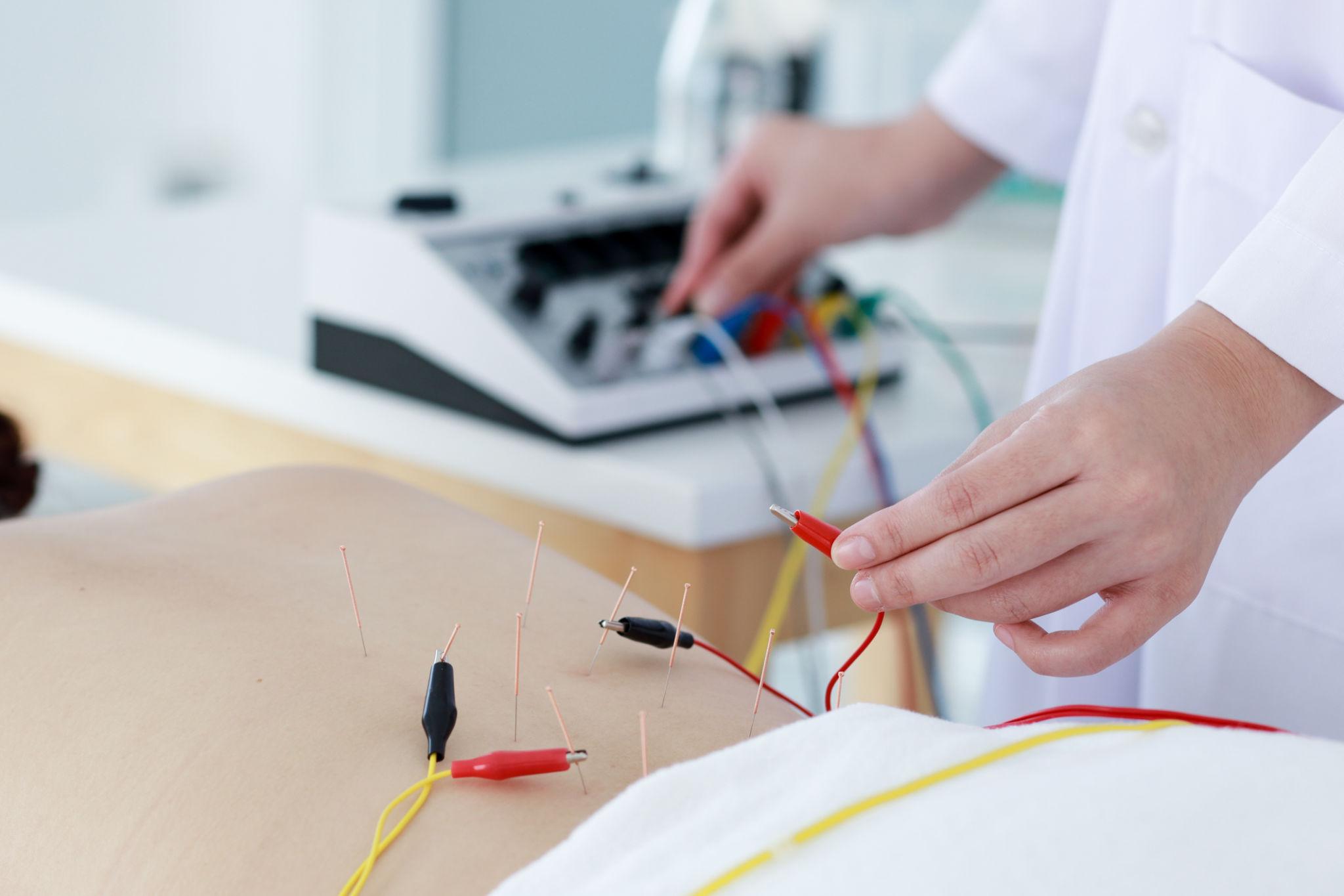 Electroacupuncture treatment